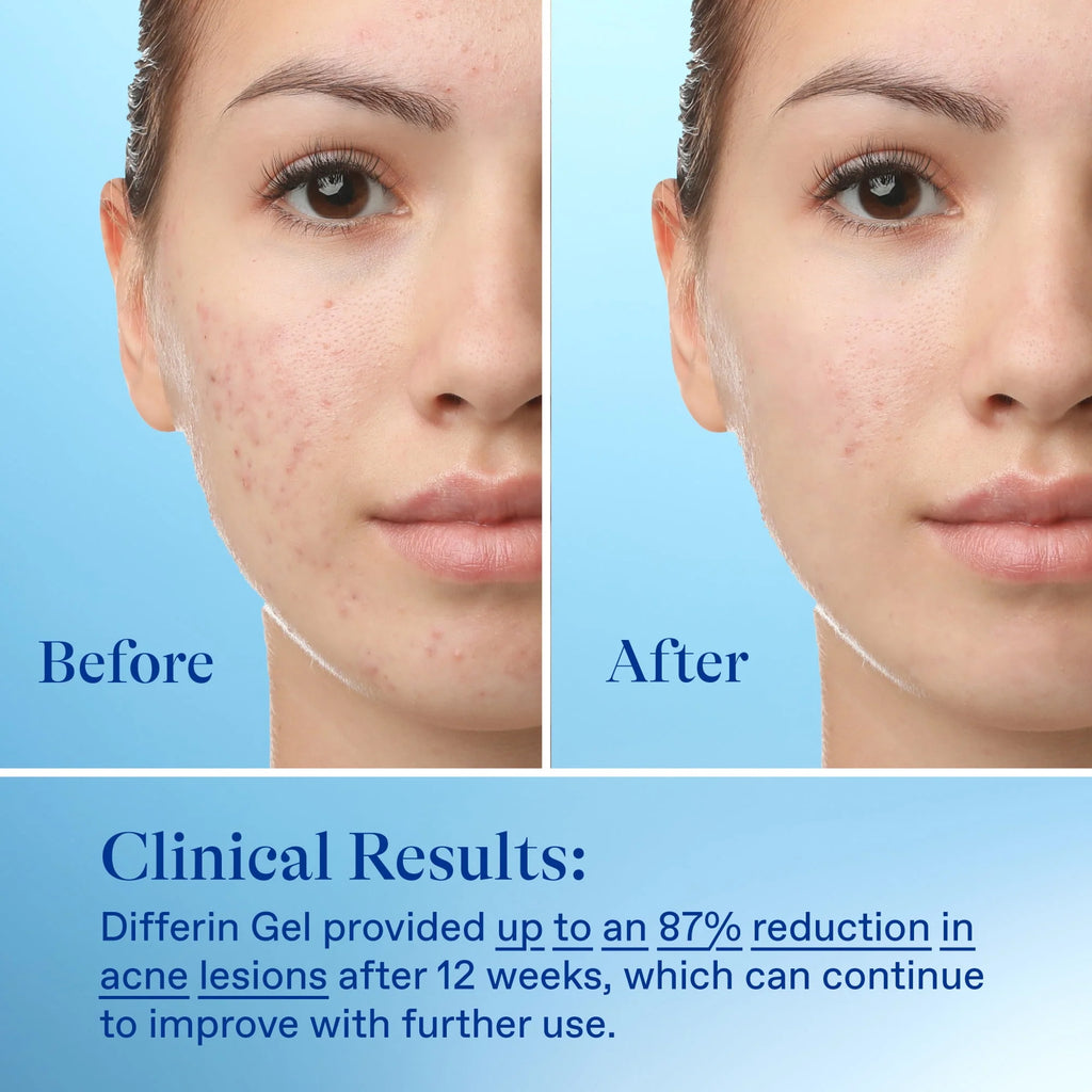 0.1% Adapalene Acne Treatment Gel H83898