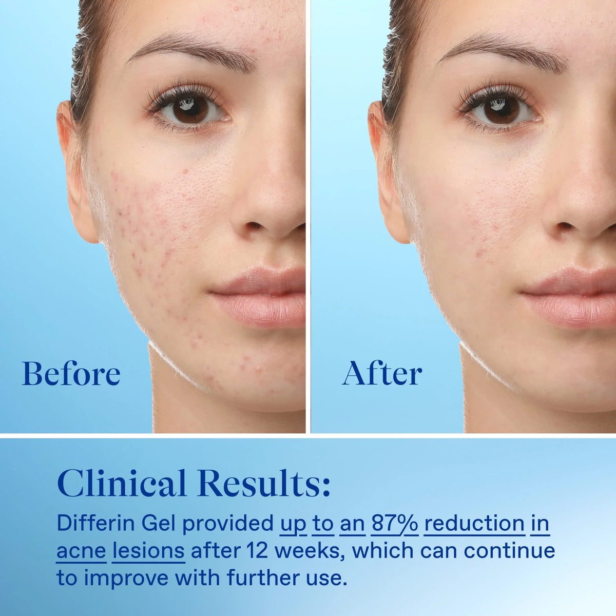 0.1% Adapalene Acne Treatment Gel H83898